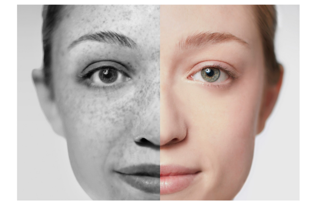 Pete pigmentare? Iată ce le cauzează cu adevărat (și cum să le tratezi blând)